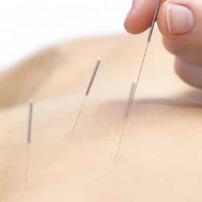 Dry needling Almere